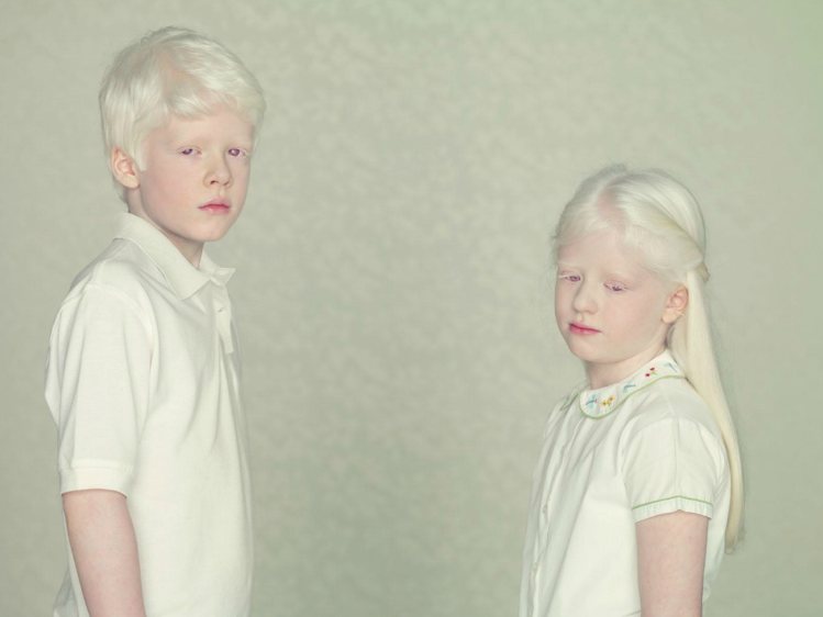 रंगहीनता (Albinism) in children